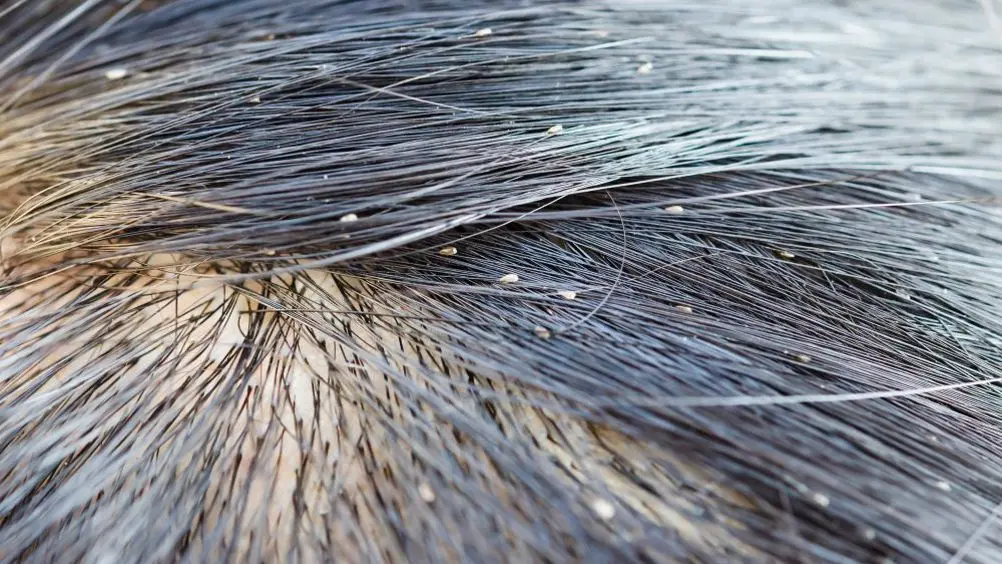 what head lice look like
