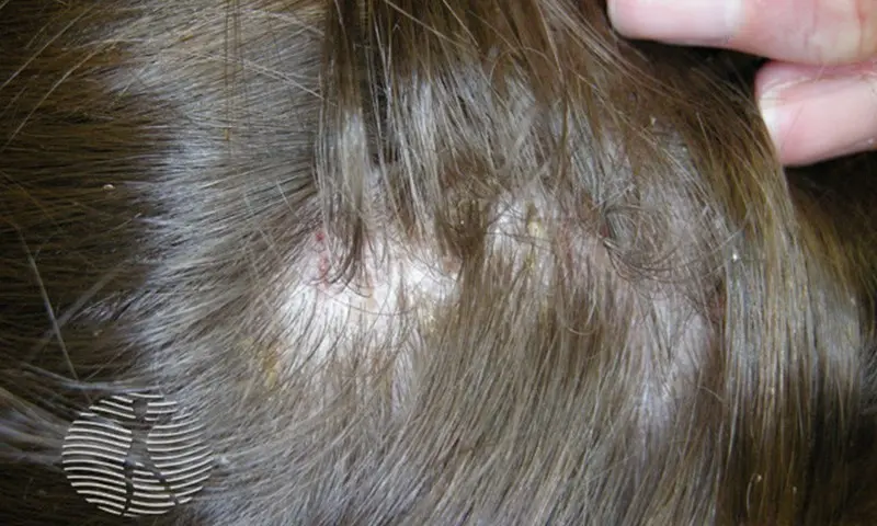 what head lice look like